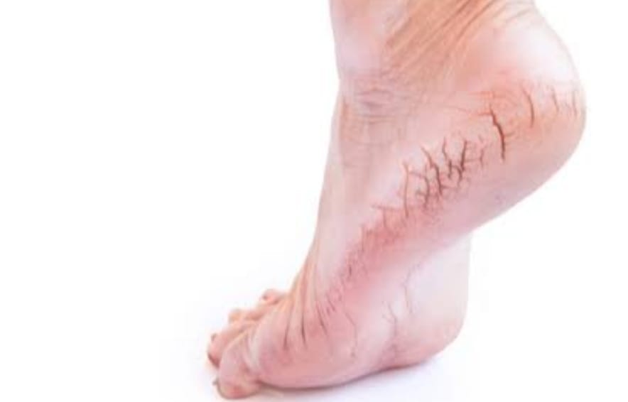 طرق فعّالة للتخلص من خشونة وتشقق القدمين