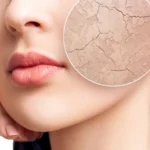 جفاف الجلد العدو الخفي لبشرتك اكتشف أسبابه المفاجئة وأفضل الطرق لعلاجه