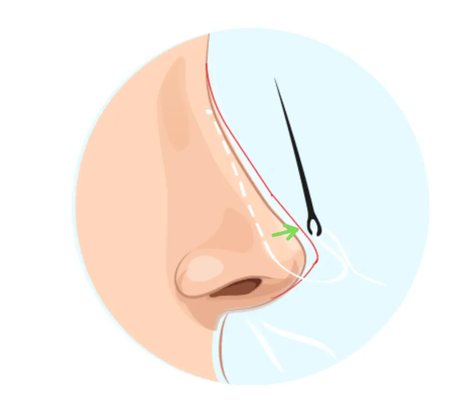 تصغير الأنف بشكل طبيعي